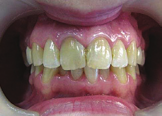 fluoroz