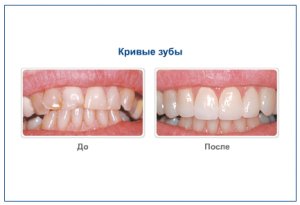 Кривые зубы