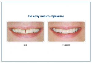 Не хочу носить брекеты