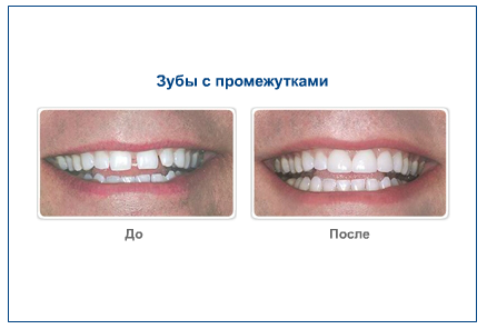 Зубы с промежутками