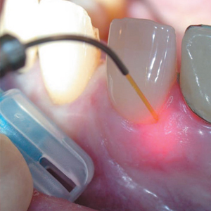 Диодный лазер в стоматологии