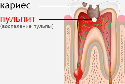 Хирургическое лечение пульпита