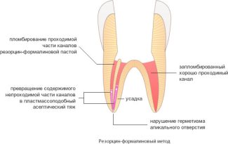 Обработка корневых каналов