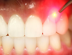 Преимущество применения лазера в стоматологической практике