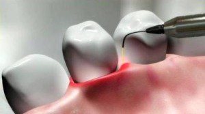 Опыт применения лазерных технологий в стоматологической практике