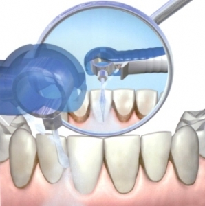 Ультразвук в практической стоматологии