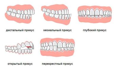 Виды прикуса