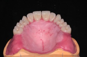 Методы формирования и полимеризации базисов зубных протезов