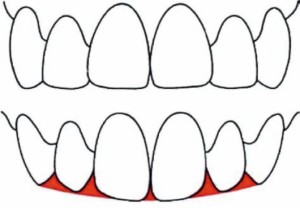 Эстетическая постановка зубов
