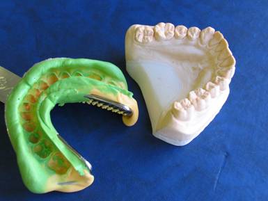 Функциональные оттиски при лечении больных с полным отсутствием зубов