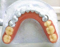 Проверка восковой конструкции протеза и постановки искусственных зубов. Ошибки при определении центрального соотношения челюстей