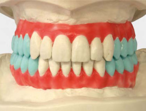 Пришлифовывание искусственных зубных рядов в артикуляторе