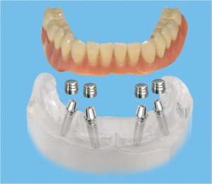 Ортопедическое лечение при полном отсутствии зубов с использованием дентальных имплантов
