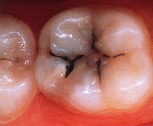 Процесс разрушения зубов и как это происходит