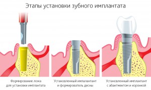 Этапы современной имплантации зуба