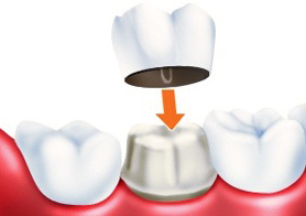 Современные коронки на зубы в наши дни