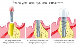 Этапы современной имплантации зуба
