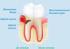 Что вызывает заболевание пародонта?