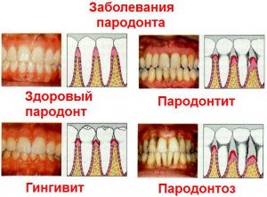 Основные причины возникновения пародонта