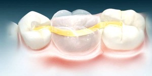 Микропротезирование зубов керамической пломбой