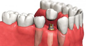 От имплантации зубов к протезированию