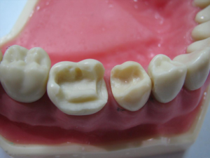 Наращивание и реставрация зубов