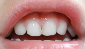 Серебрение зубов у детей и стоит ли делать?