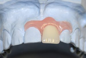 Временный зубной протез