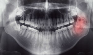 Процесс лечения гранулемы зуба
