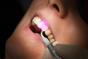 Лазер для протезирования зубов