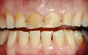 Причины патологического стирания зубов