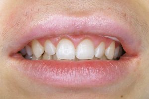 Ультраниры в стоматологии