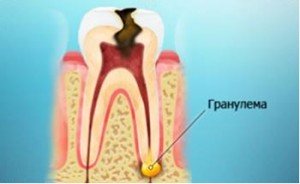 Что такое гранулема зуба?