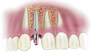 От имплантации к протезированию зубов