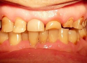 Степени и формы стираемости зубов