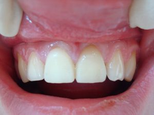 Виды временных зубных протезов