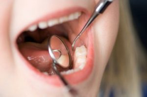 Особенности профилактики зубов
