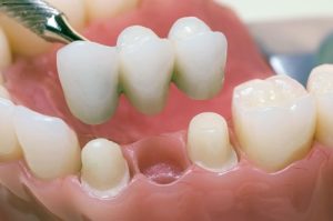 Микропротезирование зубов и надежность