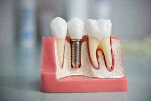 Больно ли делать имплантацию зубов?