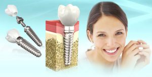 Что важно знать про имплантацию зубов?