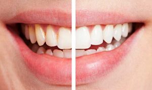 Показания и противопоказания для лазерного отбеливания зубов