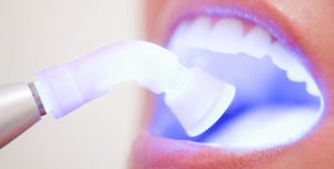 Безопасно ли лазерное отбеливание зубов?
