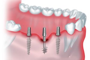 Как происходит процесс базальной имплантации зубов?