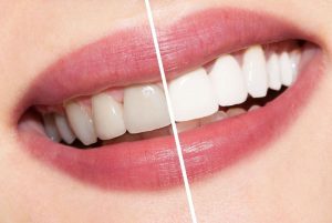Тонкости и нюансы отбеливания зубов