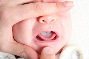 У новорожденного белый язык