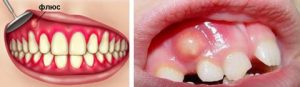 Зубной флюс и его лечение