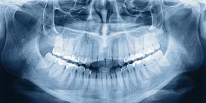 Рентген снимки челюсти и зубов
