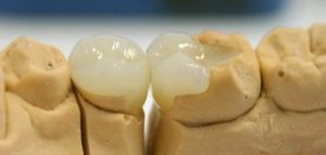 Какие пломбы на зуб лучше всего?