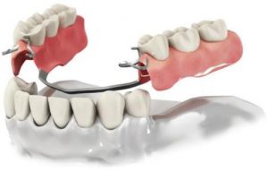 Про технологию протезирования зубов