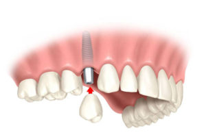 Мифы про имплантацию зубов